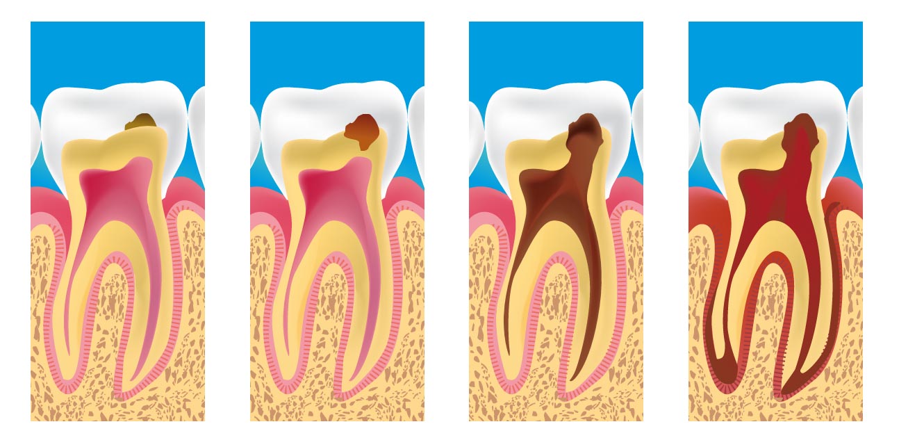 Caries dentaires