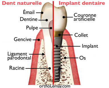 Implant dentaire