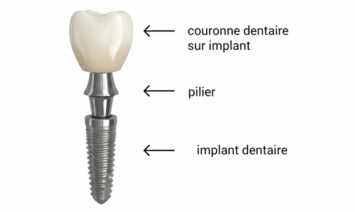Implant dentaire intégré