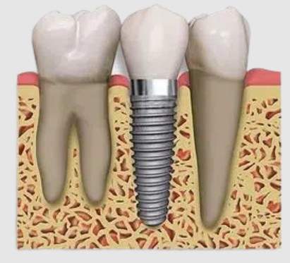 Implant dentaire en place